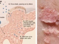 女人感染HPV图片早期症状，警惕尖锐湿疣／宫颈癌／丝状疣等疾病